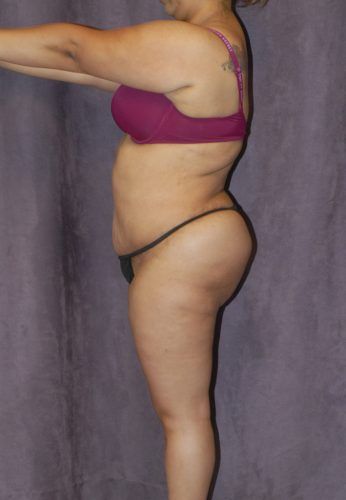 Liposuction Before & After