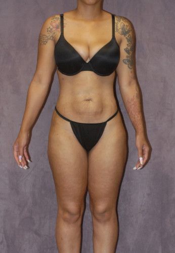 Liposuction Before & After