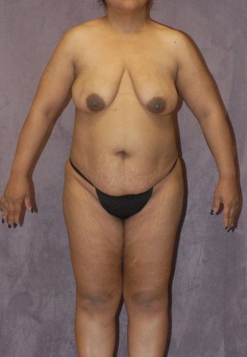 Liposuction Before & After