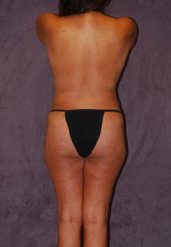 Liposuction Before & After