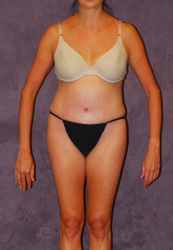 Liposuction Before & After
