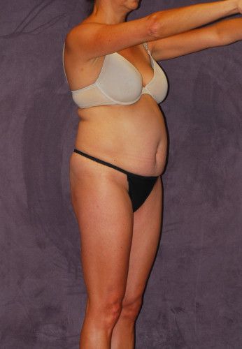 Liposuction Before & After