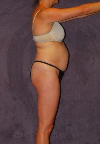 Liposuction Before & After