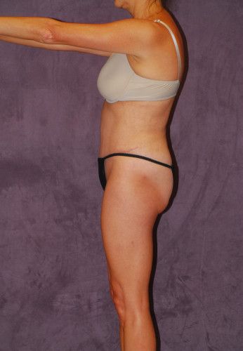 Liposuction Before & After