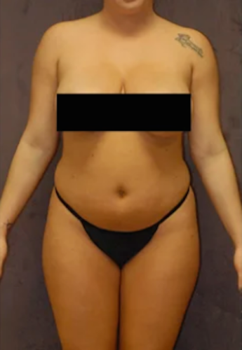 Liposuction Before & After