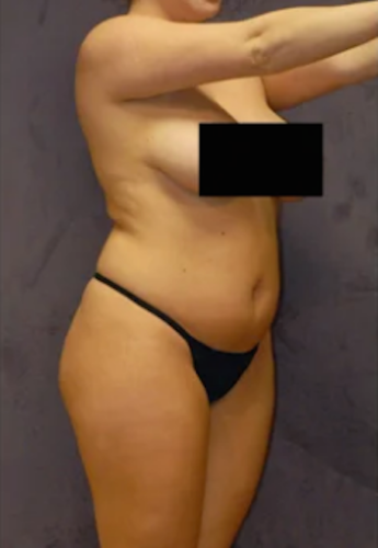Liposuction Before & After