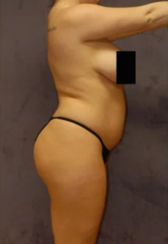 Liposuction Before & After