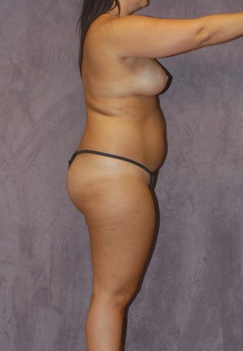 Liposuction Before & After