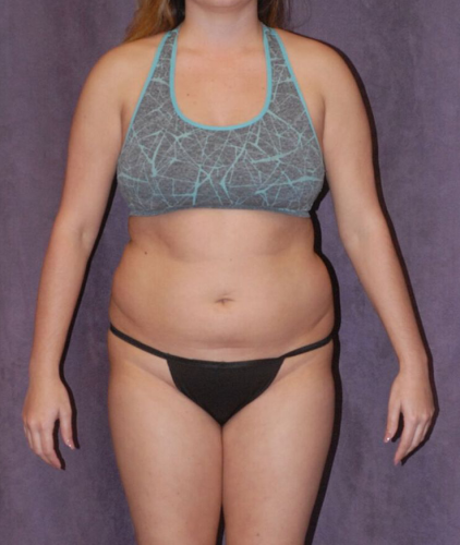 Liposuction Before & After