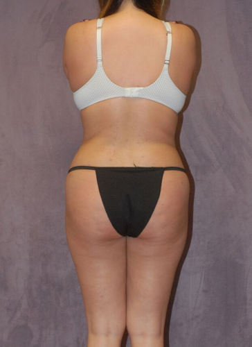 Liposuction Before & After