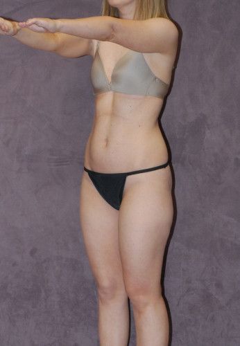 Liposuction Before & After