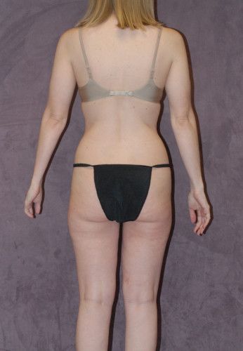 Liposuction Before & After