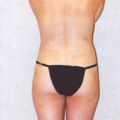 Liposuction Before & After