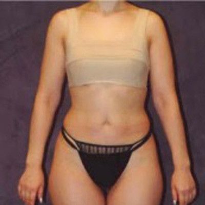 Liposuction Before & After
