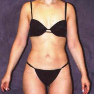 Liposuction Before & After