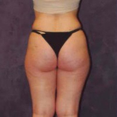 Liposuction Before & After
