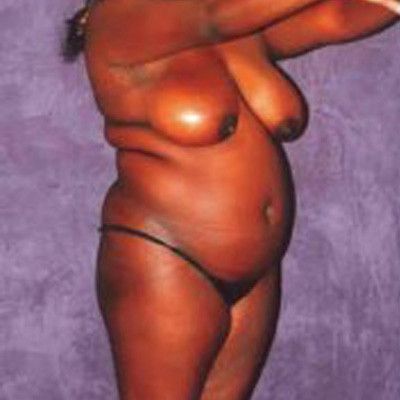 Liposuction Before & After