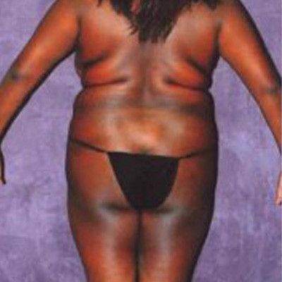 Liposuction Before & After