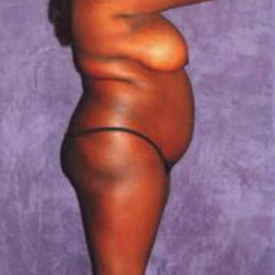 Liposuction Before & After