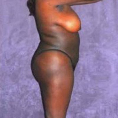 Liposuction Before & After