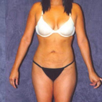 Liposuction Before & After