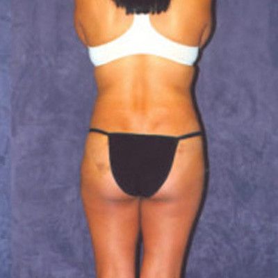 Liposuction Before & After