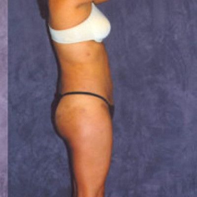 Liposuction Before & After