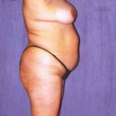 Liposuction Before & After