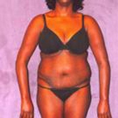 Liposuction Before & After