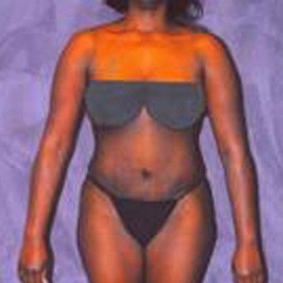 Liposuction Before & After