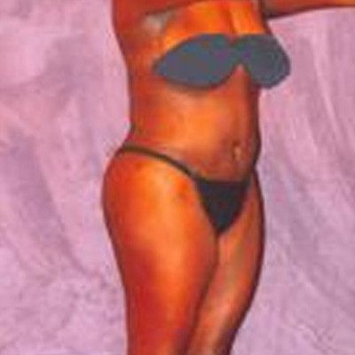 Liposuction Before & After