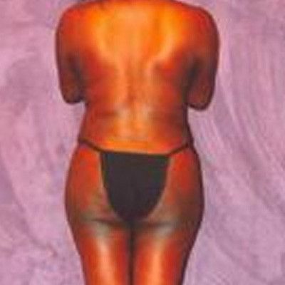 Liposuction Before & After