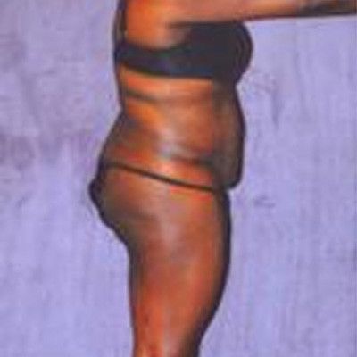 Liposuction Before & After