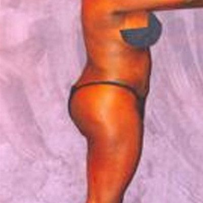 Liposuction Before & After