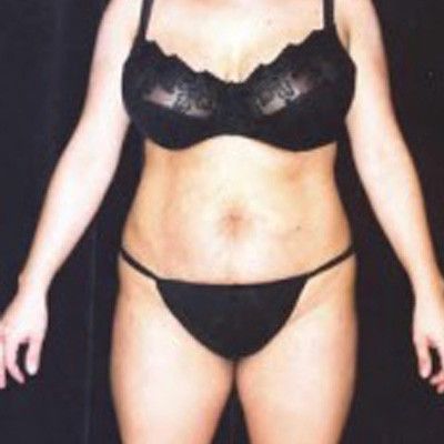 Liposuction Before & After