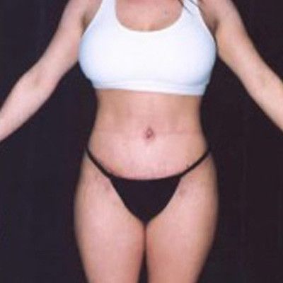 Liposuction Before & After