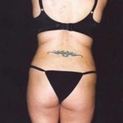 Liposuction Before & After