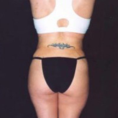 Liposuction Before & After