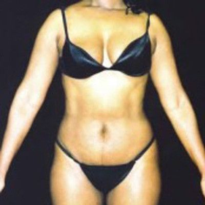 Liposuction Before & After