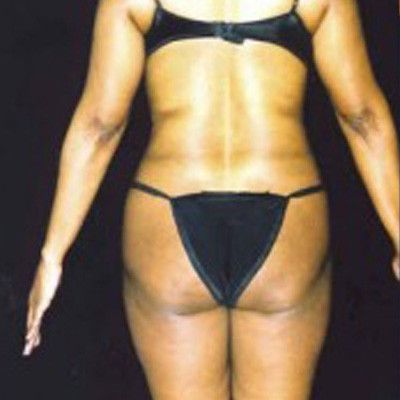 Liposuction Before & After