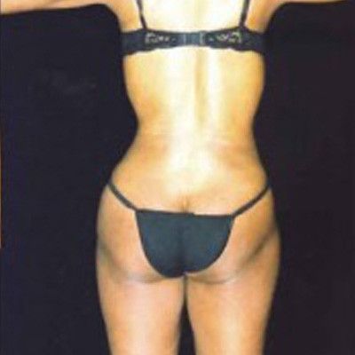 Liposuction Before & After