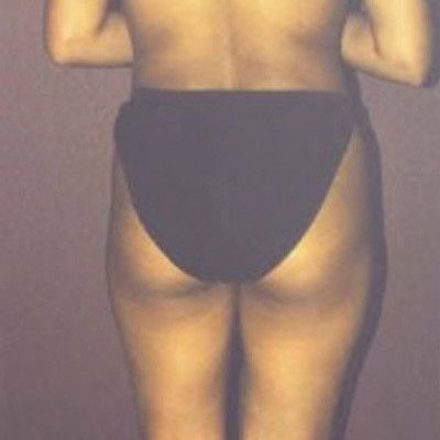 Liposuction Before & After