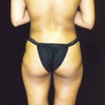 Liposuction Before & After