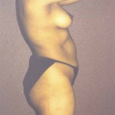 Liposuction Before & After