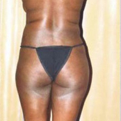 Liposuction Before & After