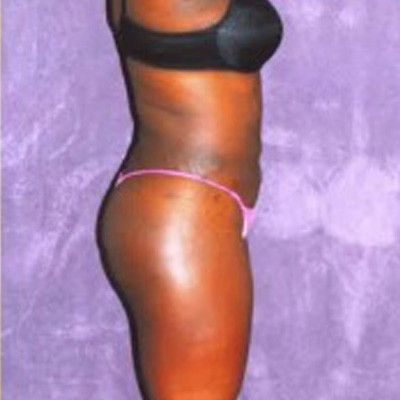 Liposuction Before & After