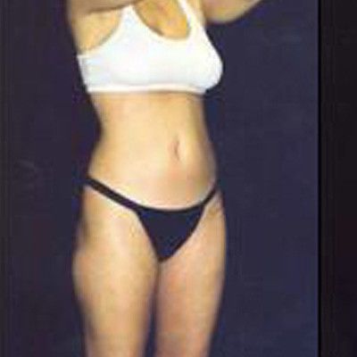 Liposuction Before & After