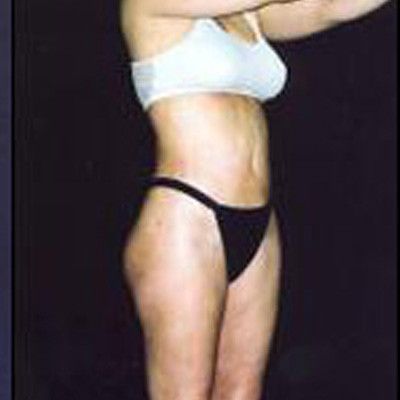 Liposuction Before & After