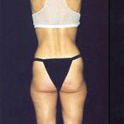 Liposuction Before & After