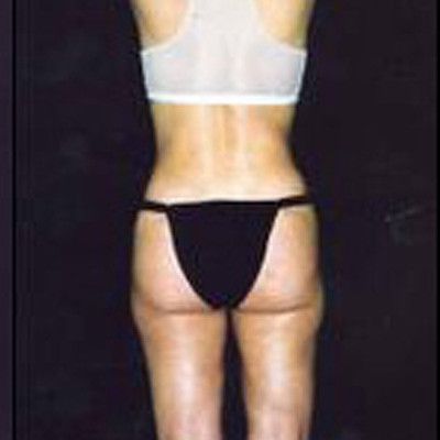 Liposuction Before & After